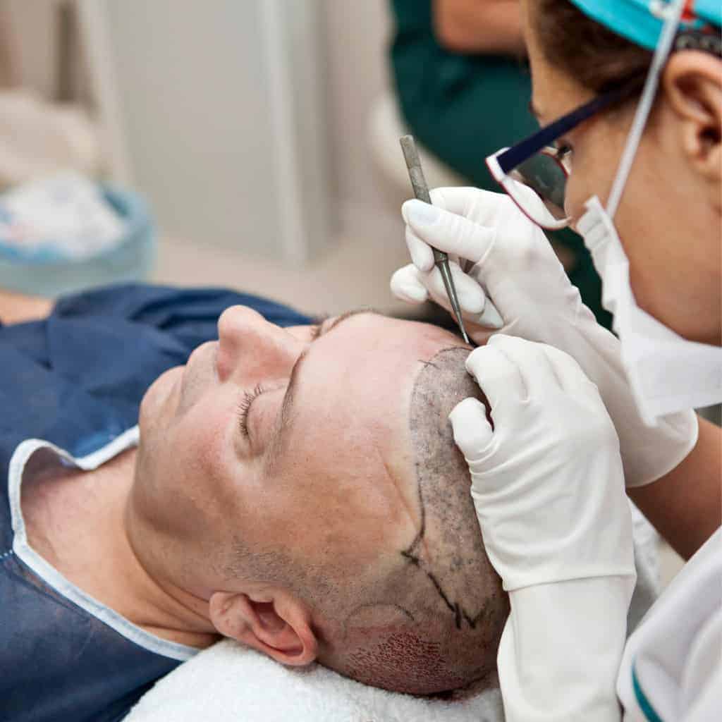 About Us Surgeon working on male FUE hair transplant