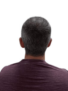 Hair Transplant Timeline Thomas 6 months post crown ht