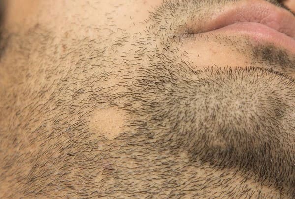 Alopecia Barbae alopecia barbae patchy hair loss on beard