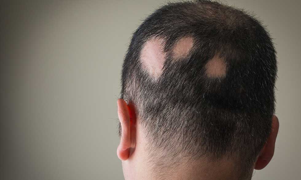 Alopecia alopecia-what-you-need-to-know