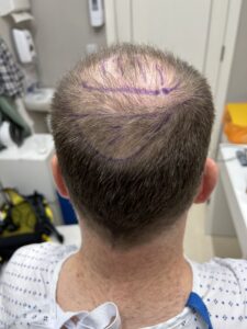 back of head day of surgery
