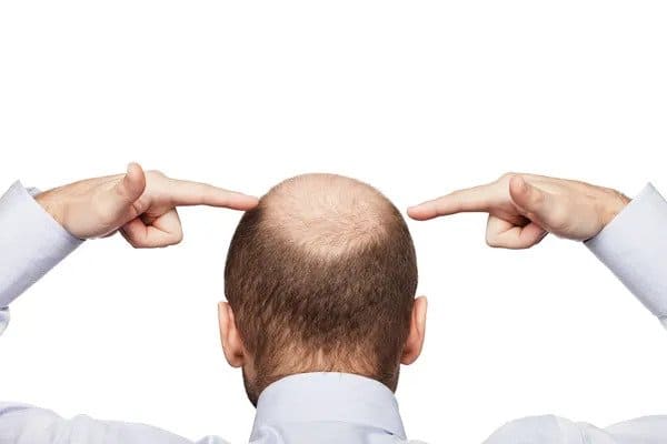 bald man looking for a cure