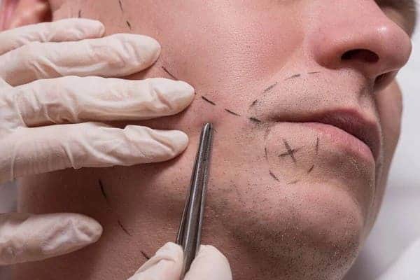 Beard Transplant Side Effects beard transplant side effects