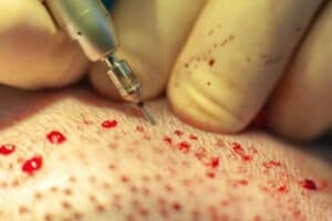 body hair extraction