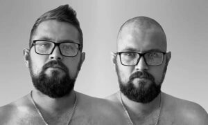 body hair transplant for men