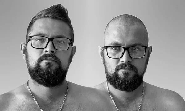 Body Hair Transplants body hair transplant for men