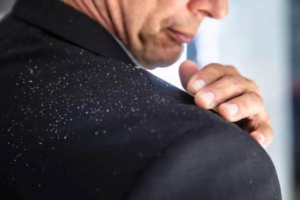 Does Dandruff Cause Hair Loss? can dandruff cause hair loss