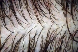 dandruff and hair loss