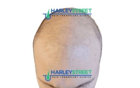 Diffuse Hair Loss man with diffuse hair loss
