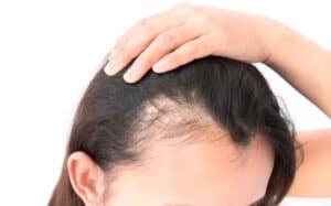 female hair loss on the temples