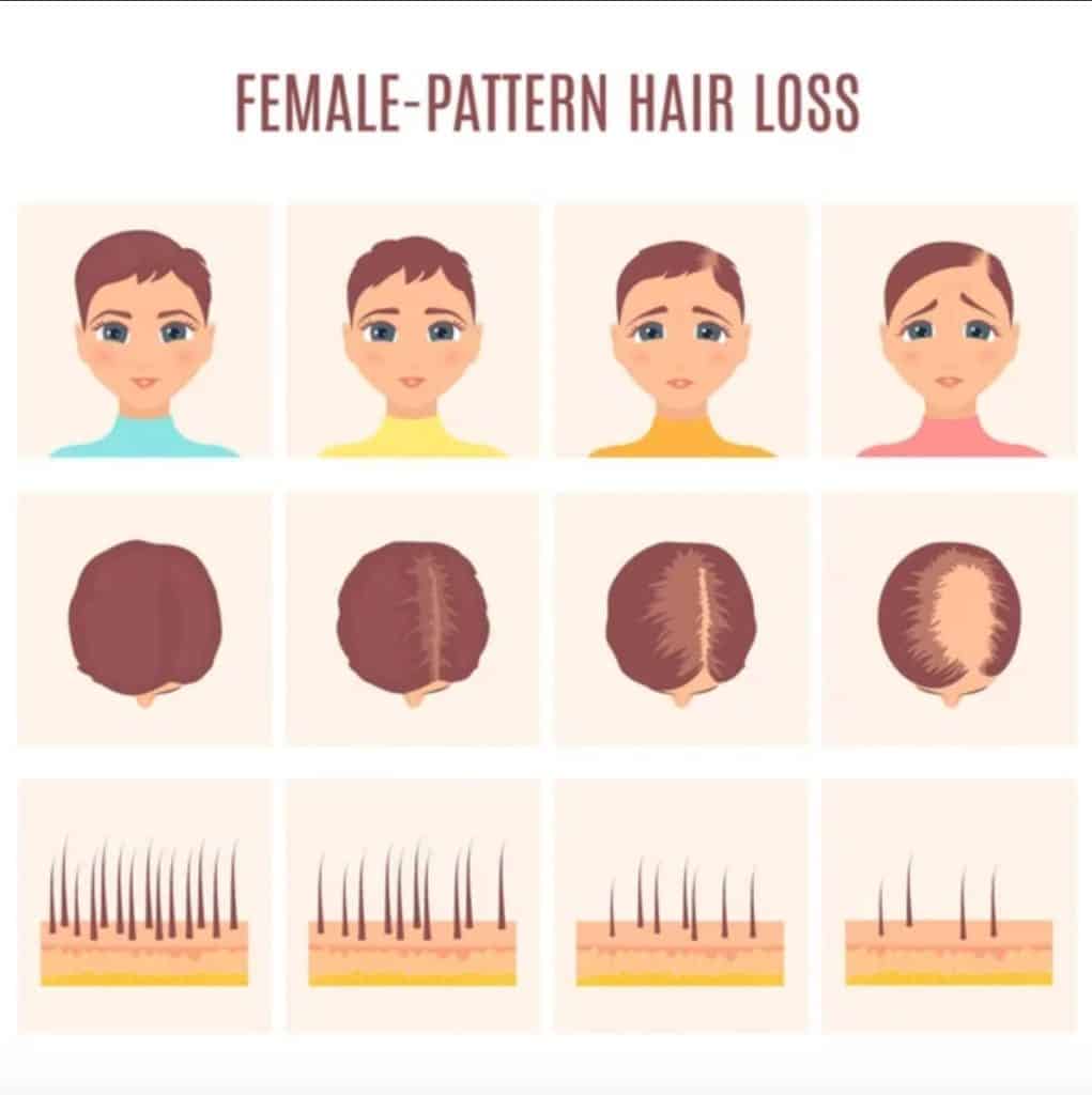 female pattern hair loss
