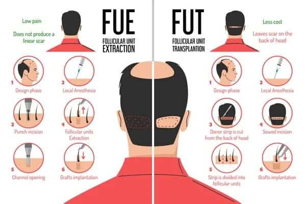 FUE vs FUT Hair Transplant fue vs fut hair transplant
