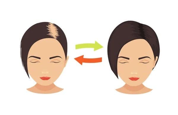 Hair Loss in Women hair loss in women and why hair transplants aren't always a good choice