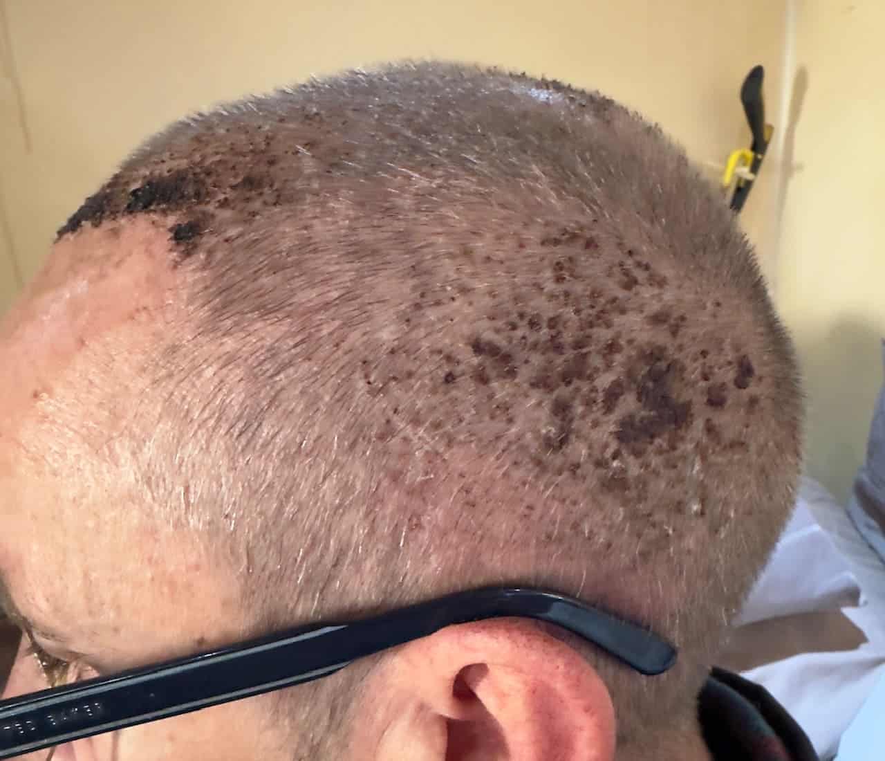 Hair Transplant Scabs hair transplant scabs 2 weeks