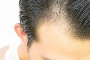 hairloss due to vitamin b12 deficiency