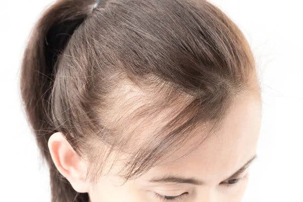 Illnesses That Cause Hair Loss in Women illnesses that cause hair loss in women