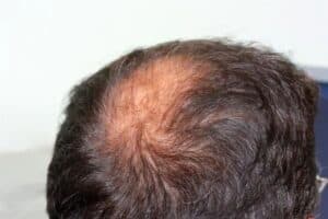 man with dry and clean scalp with crown thinning