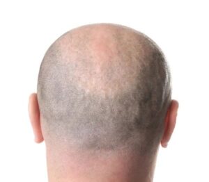 not enough scalp donor area