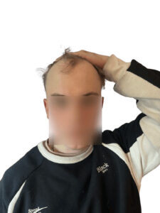 patient with receding hairline