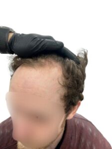 recipient area for a hair transplant