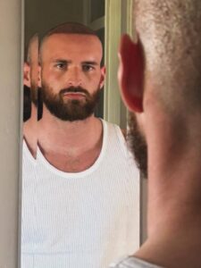 ronnie vint hair transplant at harley street hair transplant clinics