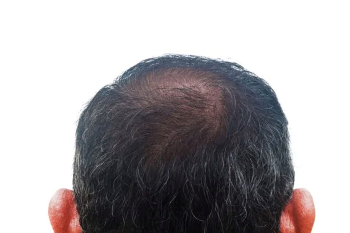 Telogen Effluvium telogen effluvium