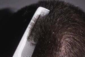 what is dandruff