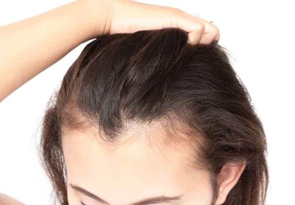 Receding Hairline in Women woman with a receding hairline